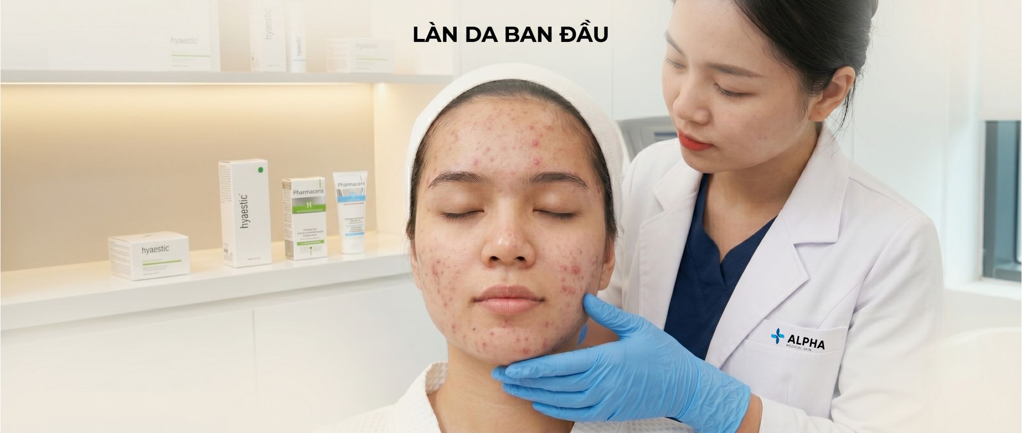 Da trước điều trị mụn